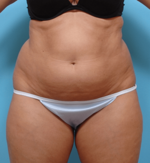 Manhattan liposuction before 6